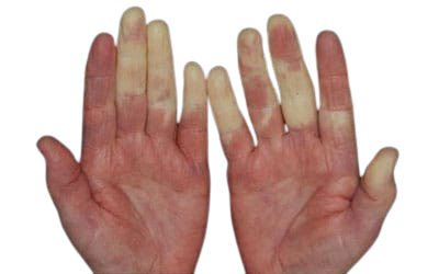 Síndrome de Raynaud (dedo blanco vibracional):